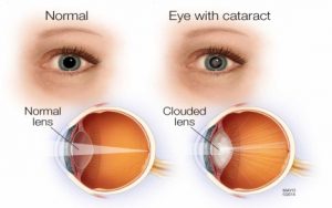 Free Cataract Treatment in Bagdogra