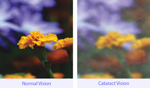 Cataract Vision