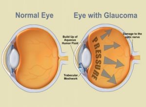 glaucoma-1