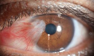 pterygium