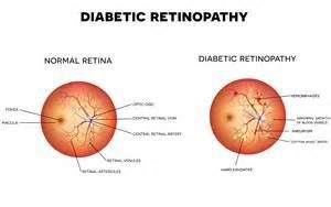 Example of Retinopathy